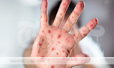 Measles Alert Issued for Northern NSW Residents