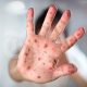 Measles Alert Issued for Northern NSW Residents