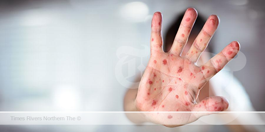 Measles alert for northern NSW