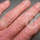 Psoriatic Arthritis and Raynaud's Syndrome