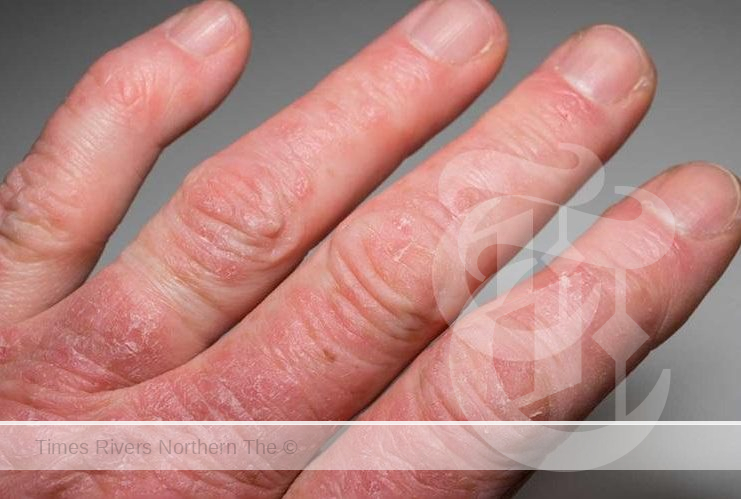 Psoriatic Arthritis and Raynaud's Syndrome