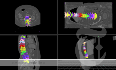 An example of spinal segmentation software. CSIRO