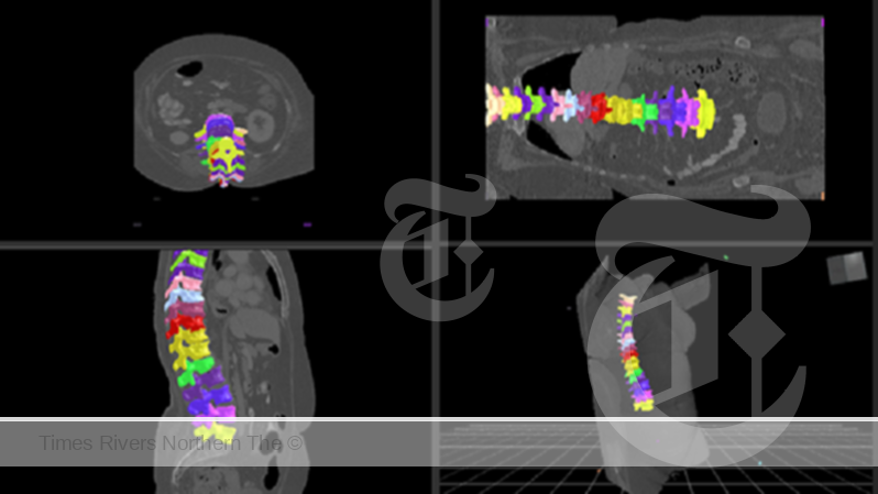 An example of spinal segmentation software. CSIRO